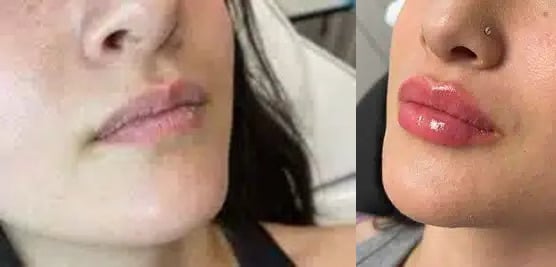 Dermal Filler Before & After | Radiant Skin