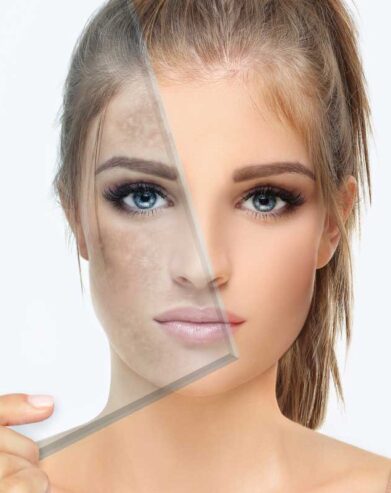 microlaserpeel treatment