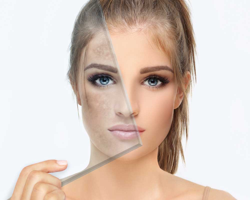 microlaserpeel treatment